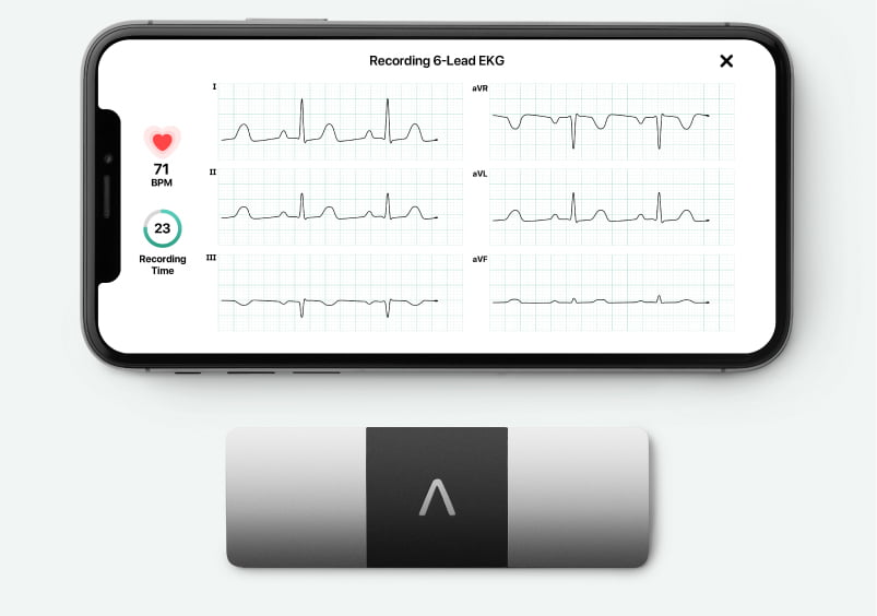 Kardia Mobile 6L paired with an iPhone taking a 6-lead EKG
