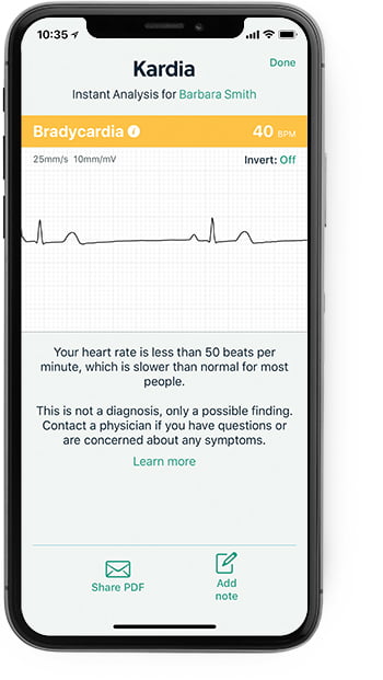 iPhone showing the Kardia app with a bradycardia result